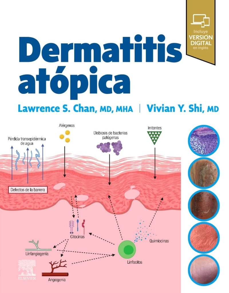 Dermatitis Atópica Elena Zamora Martínez