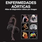 Enfermedades Aorticas